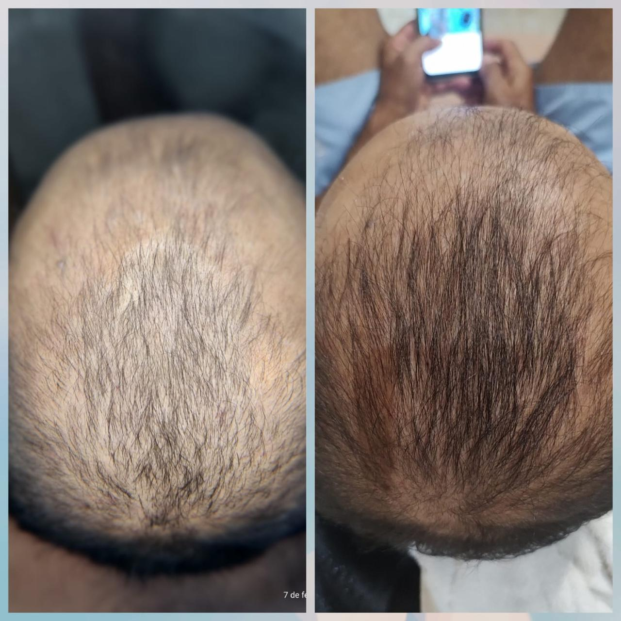 Cabelo de uma cliente antes do tratamento de queda de cabelo em Jundiaí.